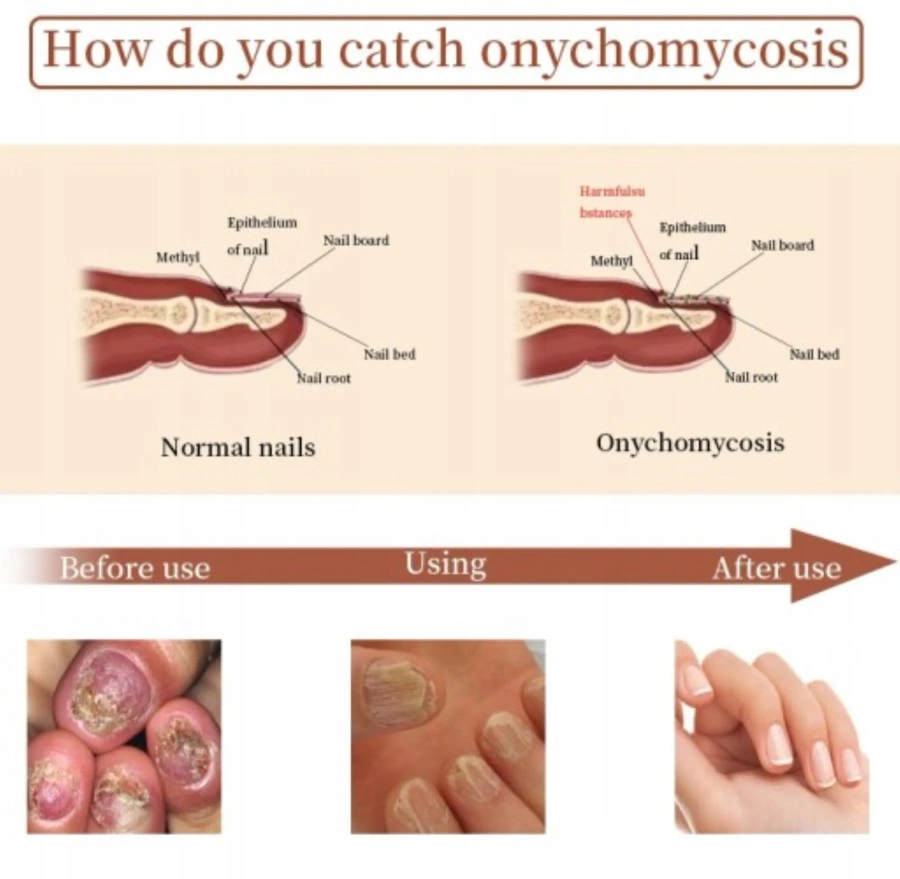 Płyn przeciwgrzybiczny z odbudową wzrostu do naprawy paznokcia 20 ml