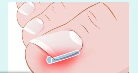 Paski na wrastające paznokcie 10 szt.